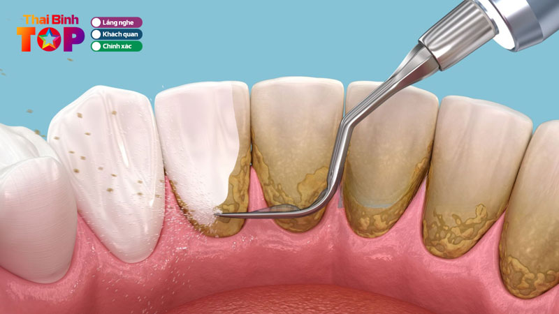 Top-10-dia-chi-cao-voi-rang-o-thai-binh-dang-tin-cay-thaibinhtoplist