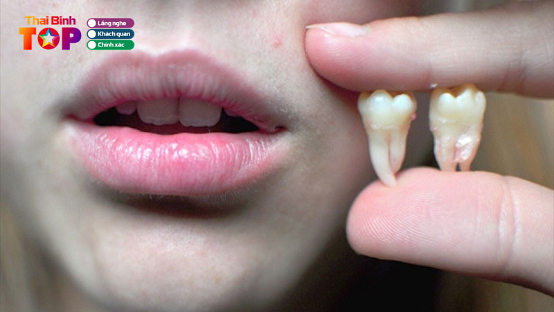 Top-6-dia-chi-nho-rang-khon-o-thai-binh-uy-tin-chuyen-nghiep-thaibinhtoplist