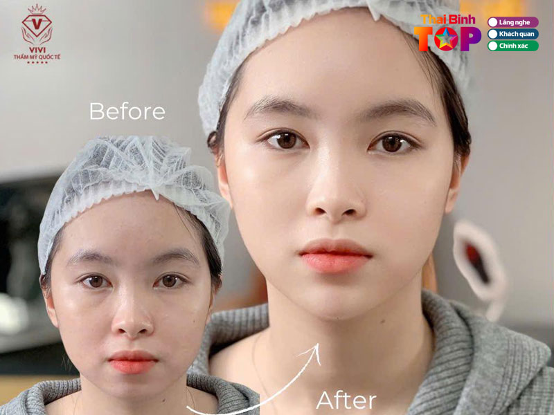 Tham-my-vivi-filler-botox-thaibinhtoplist