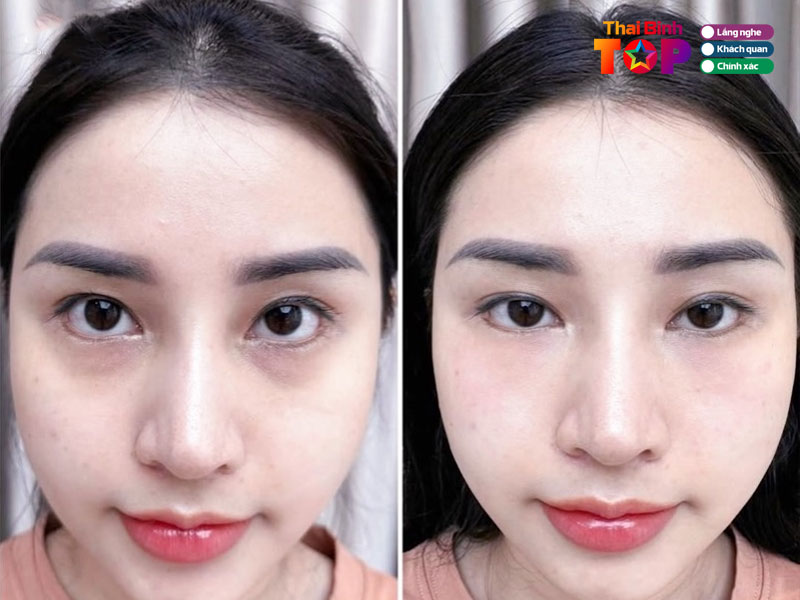 Bi-quyet-khi-lua-chon-noi-tri-quang-tham-mat-hieu-qua-thaibinhtoplist