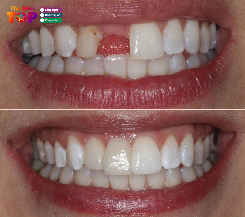 Cau-rang-su-la-gi-giai-phap-phuc-hinh-rang-mat-co-dinh-1-thaibinhtoplist