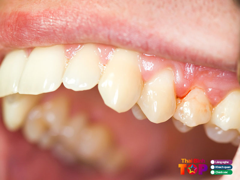 Kinh-nghiem-khi-lua-chon-nha-khoa-dieu-tri-nha-chu-hieu-qua-thaibinhtoplist