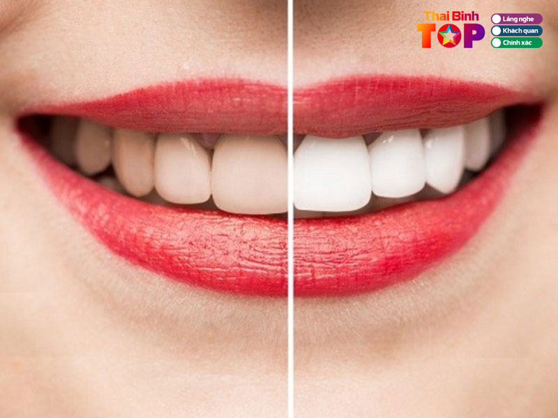 Tieu-chi-chon-dia-chi-tay-trang-rang-uy-tin-thaibinhtoplist