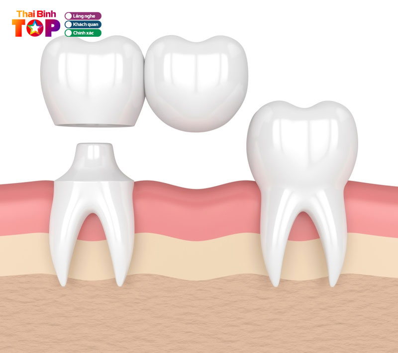 Uu-diem-cua-cau-rang-su-trong-phuc-hinh-rang-mieng-thaibinhtoplist