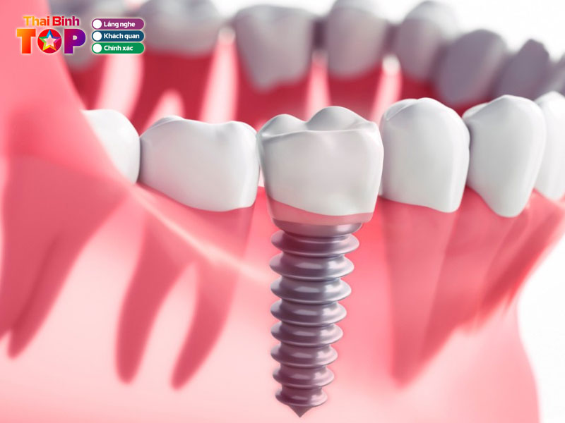 Tieu-chi-chon-dia-chi-trong-rang-implant-thai-binh-thaibinhtoplist