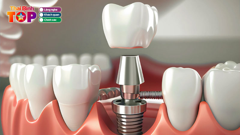 Top-10-dia-chi-trong-rang-implant-thai-binh-cong-nghe-tien-tien-thaibinhtoplist