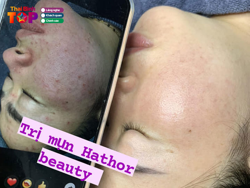 Hathor-beauty-dia-chi-tri-mun-thai-binh-uy-tin-thaibinhtoplist