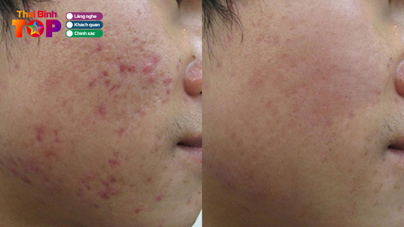 Top-12-dia-chi-tri-mun-thai-binh-uy-tin-an-toan-khong-nen-bo-lo-thaibinhtoplist